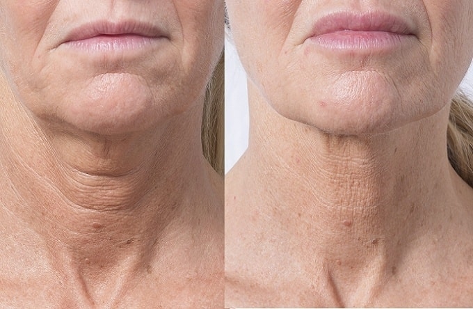 Lão hóa da cổ mức độ nặng