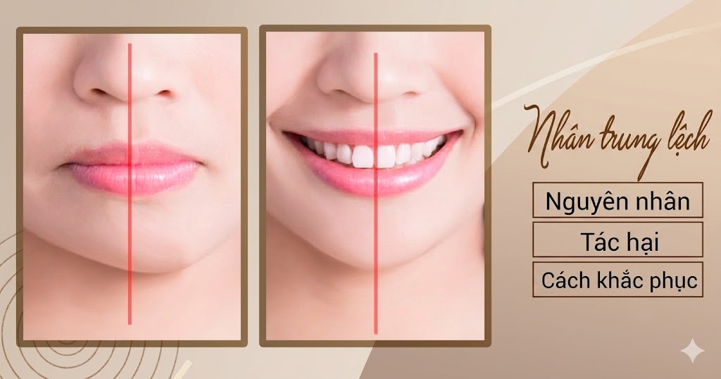 Nhân trung lệch là gì? Dấu hiệu nhận biết