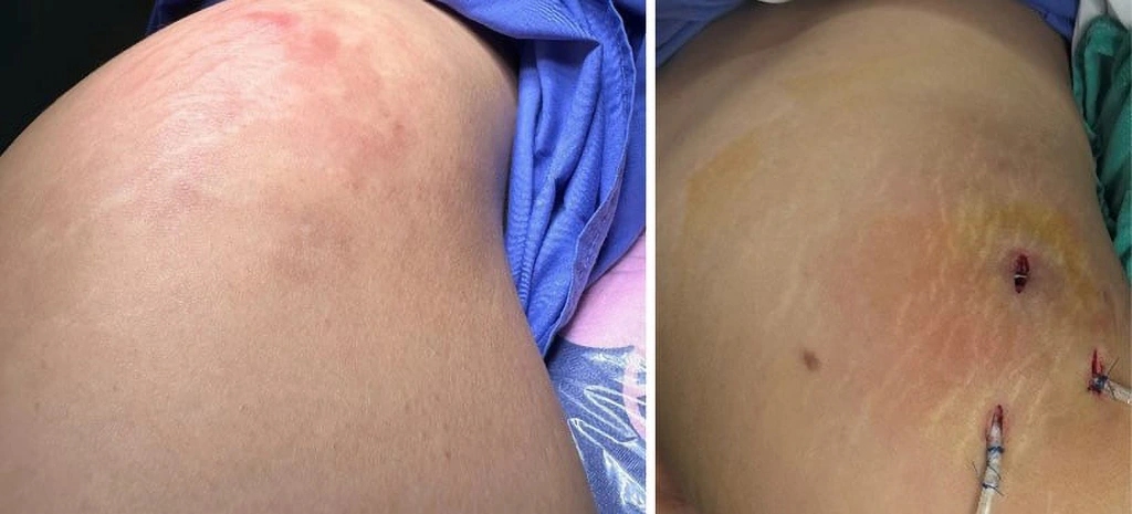 Những biến chứng tiềm ẩn cần cảnh báo khi tiêm filler mông