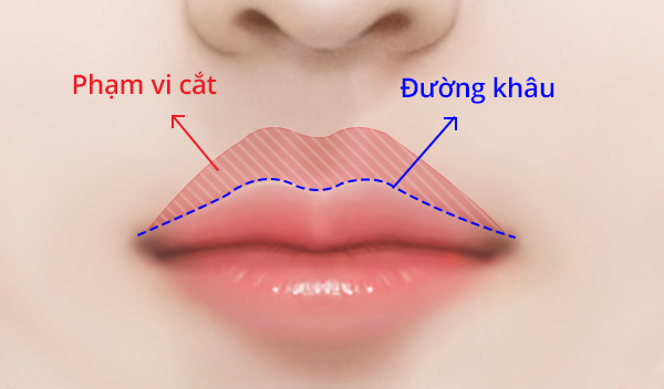Phẫu thuật tạo hình nhân trung