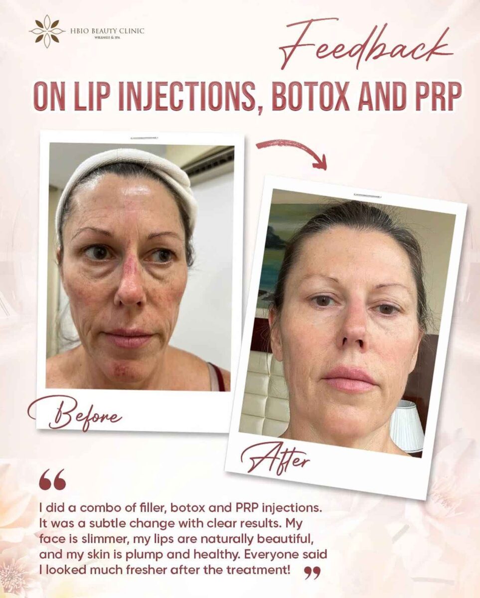 PRP - Huyết tương giàu tiểu cầu