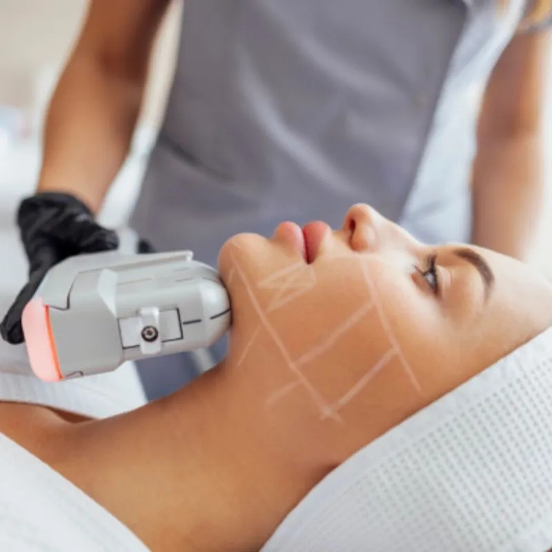 Thermage FLX bao lâu nên được thực hiện một lần
