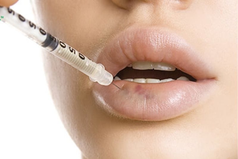 Tiêm quá thường xuyên khi filler cũ chưa tan