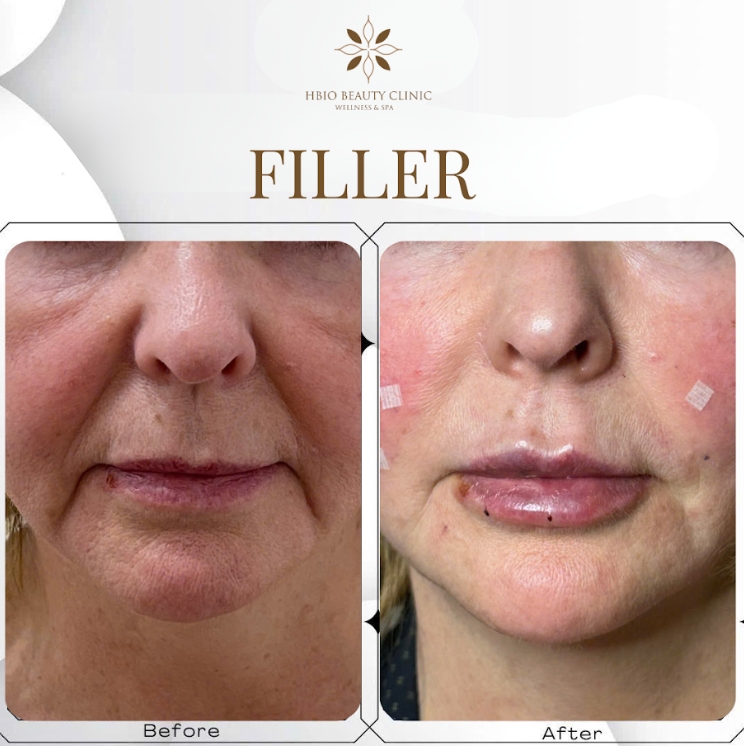 Tiêm filler làm rõ nét nhân trung tại HBIO 