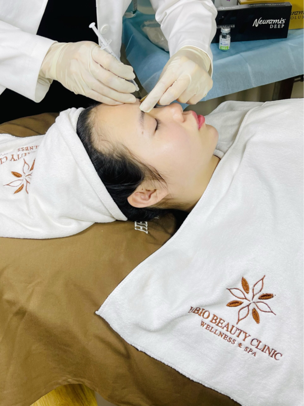 Cách khắc phục hiện tượng tiêm filler rãnh cười bị tràn an toàn