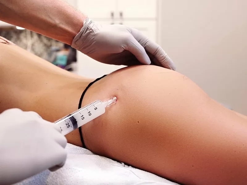 Tiêm mông filler