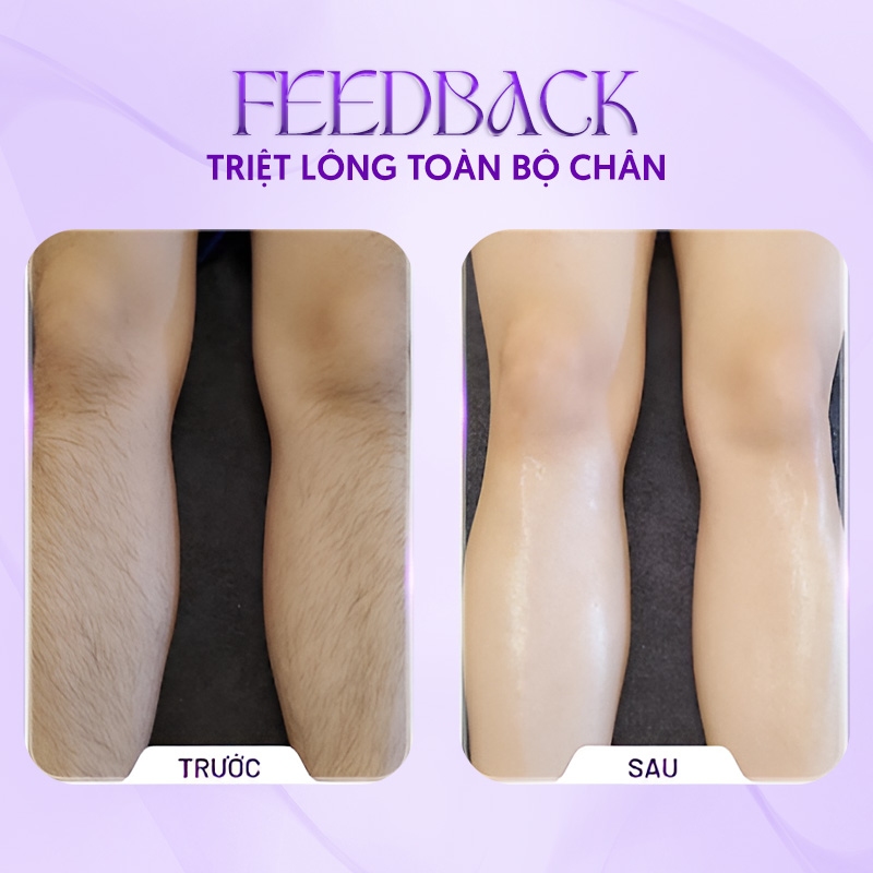 Trước và sau khi triệt lông tại HBIO CLINIC