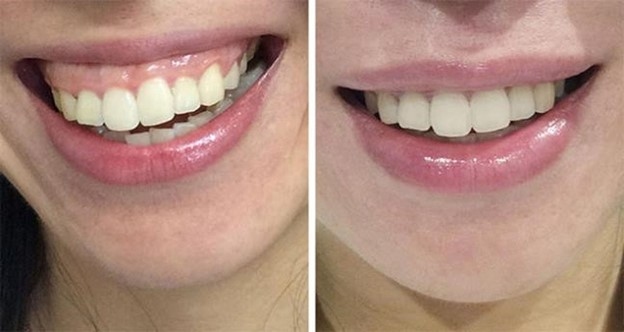 Ưu điểm vượt trội của phương pháp tiêm Botox cười hở lợi
