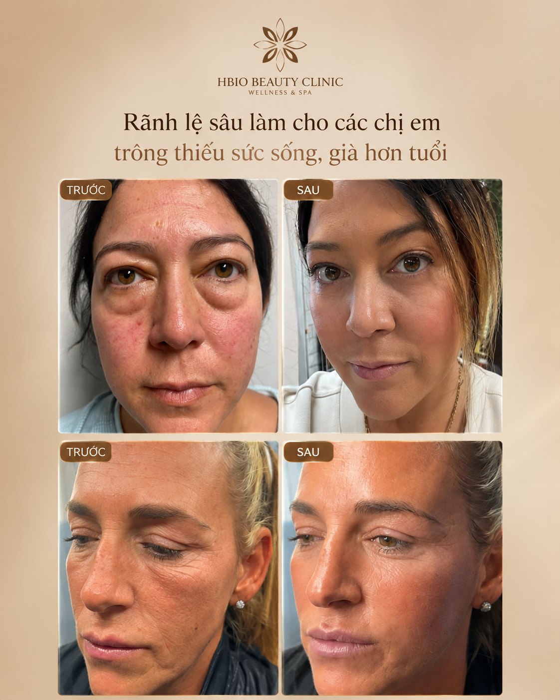 Giải pháp xóa rãnh lệ chuyên sâu tạo HBIO Clinic