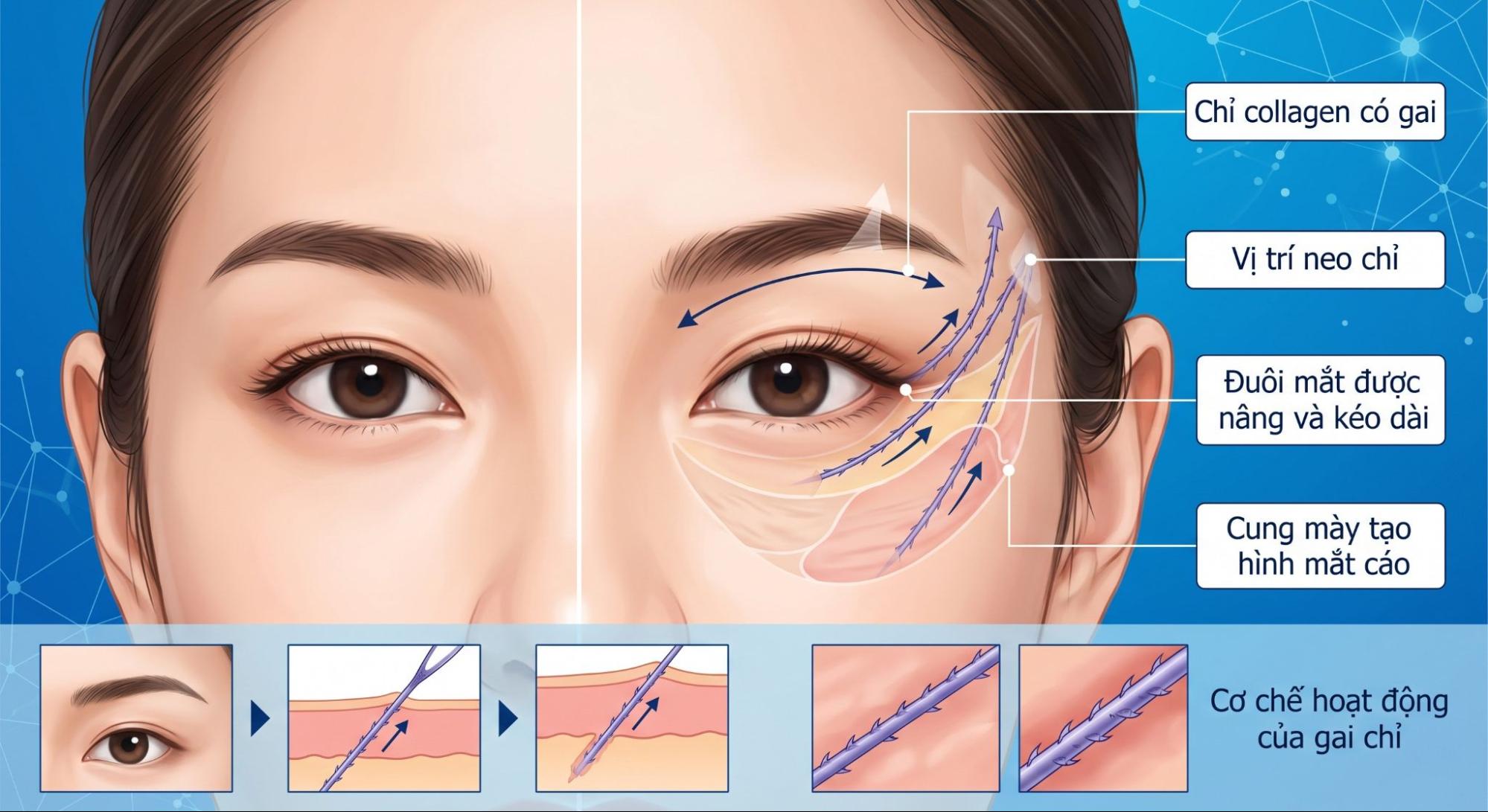 Ai phù hợp với căng chỉ mắt cáo