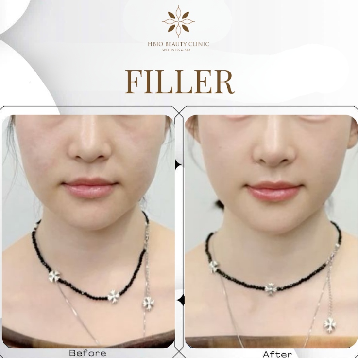 Tiêm filler tại HBIO Clinic