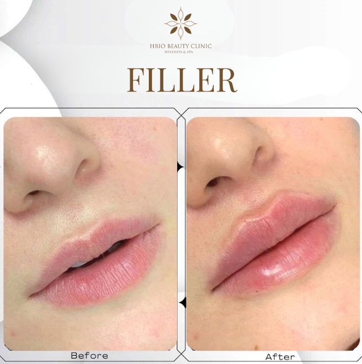 Quá trình hồi phục của khách hàng tiêm filler tại HBIO Clinic