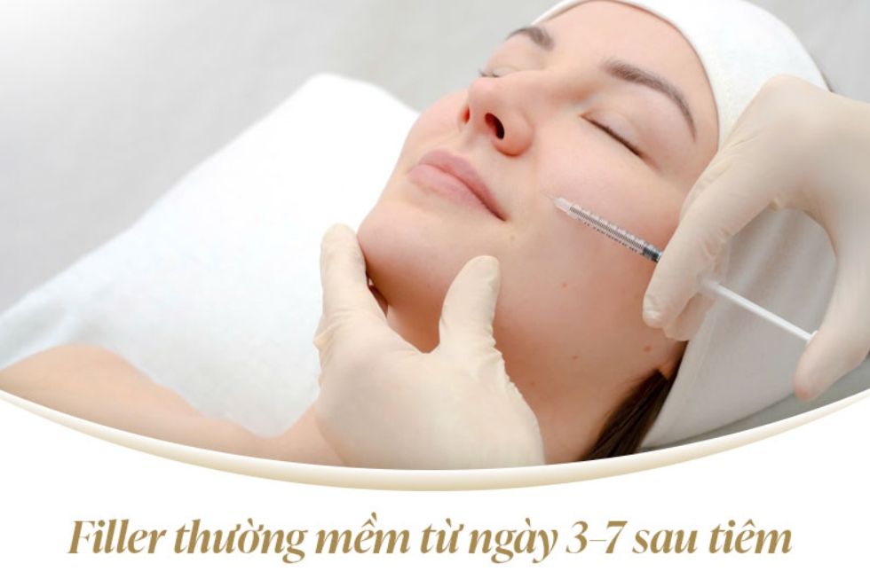 Tiêm filler bao lâu thì mềm?