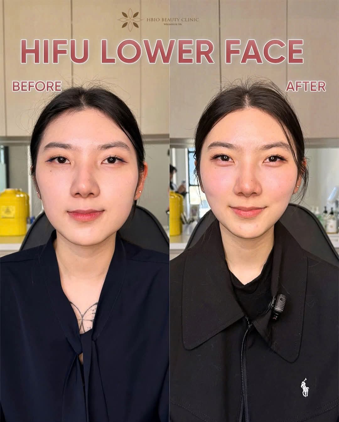 Căng chỉ hoặc các phương pháp trẻ hóa da