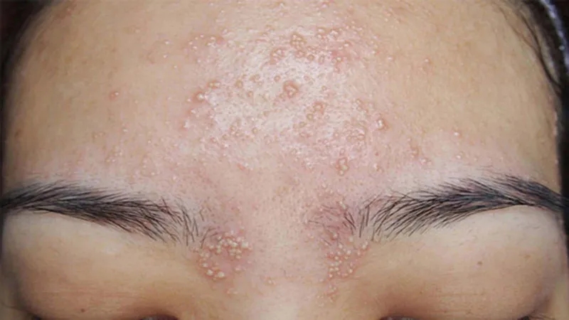 Peel da bị nổi mụn nước có nguy hiểm không?