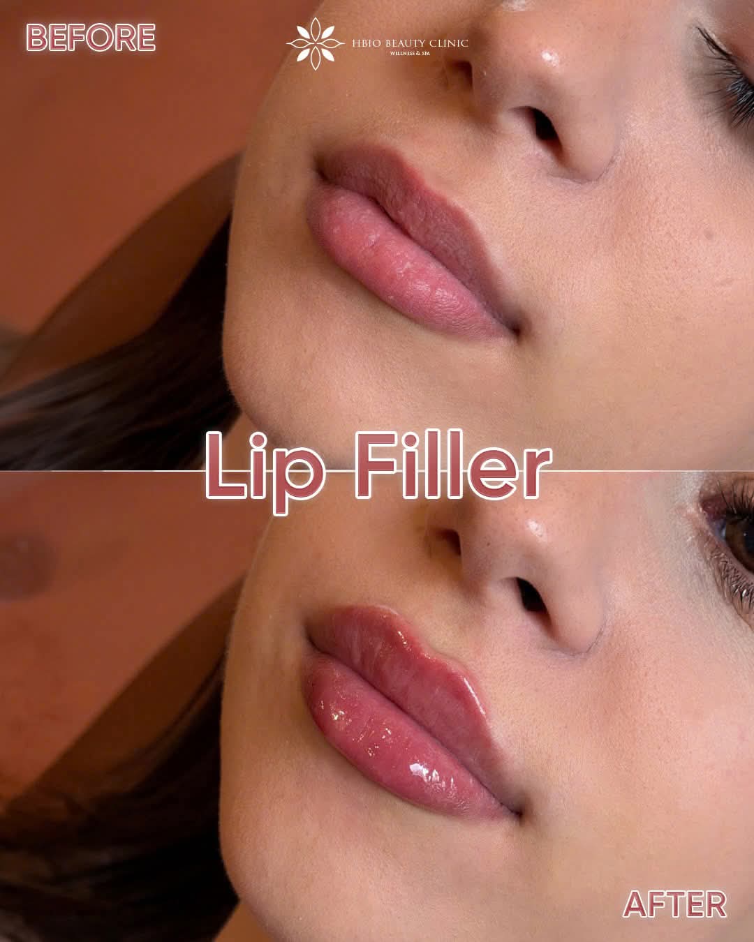 Ảnh trước và sau khi filler môi tại HBIO Clinic