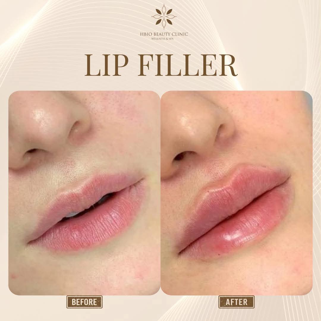 Ảnh trước và sau khi filler môi tại HBIO Clinic