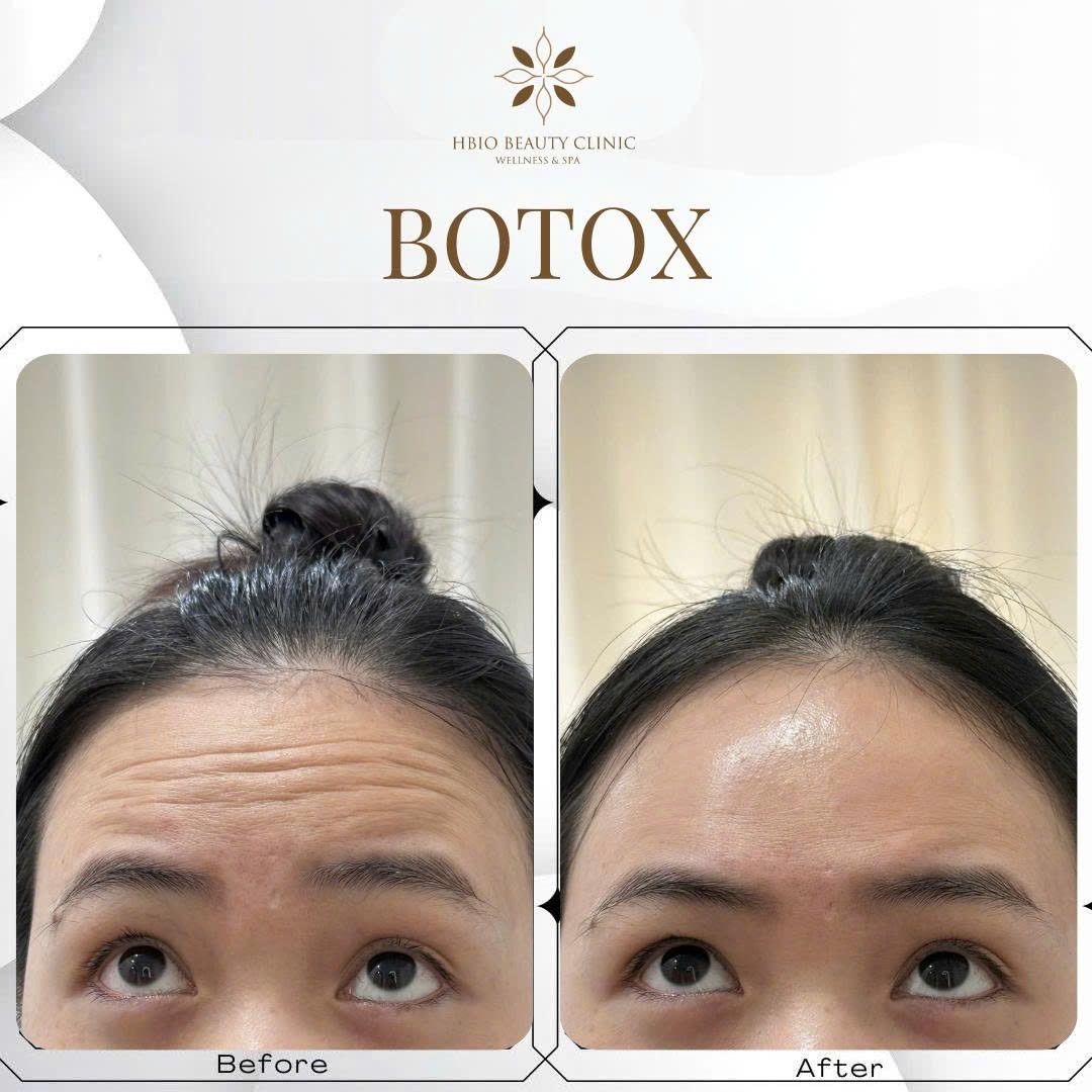 Địa chỉ trẻ hóa bằng botox an toàn chuẩn y khoa
