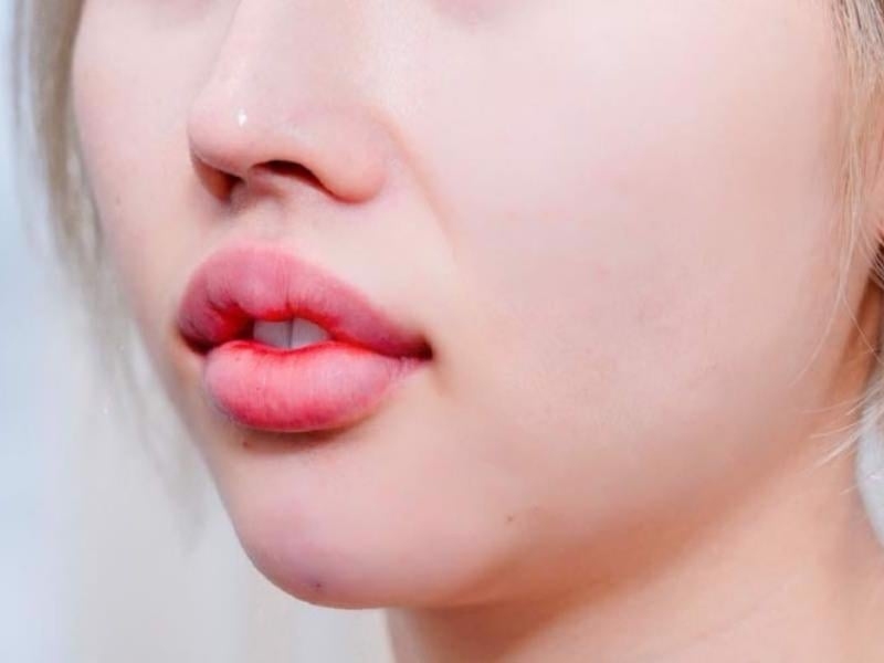 Dấu hiệu môi bị sưng sinh lý sau khi thực hiện tiêm filler môi