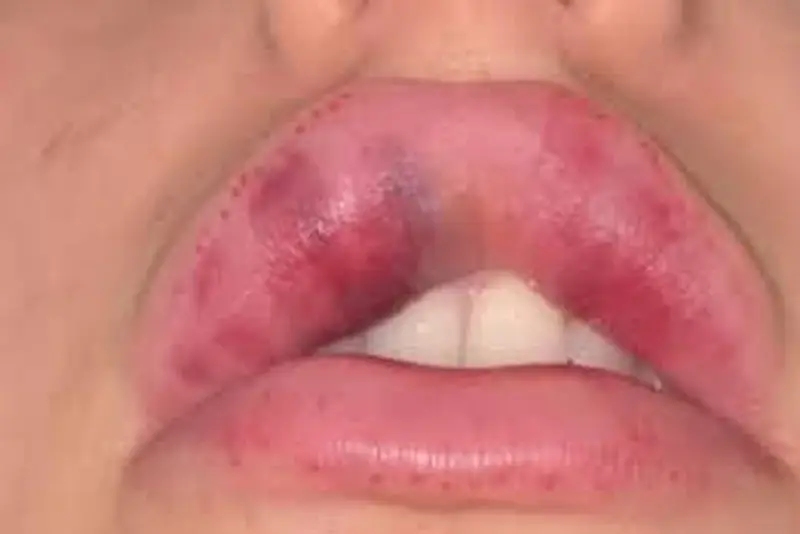 Dấu hiệu môi bị biến chứng nặng khi tiêm filler môi