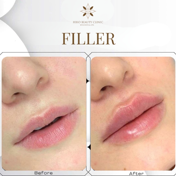 Tiêm Filler môi tại HBIO Clinic