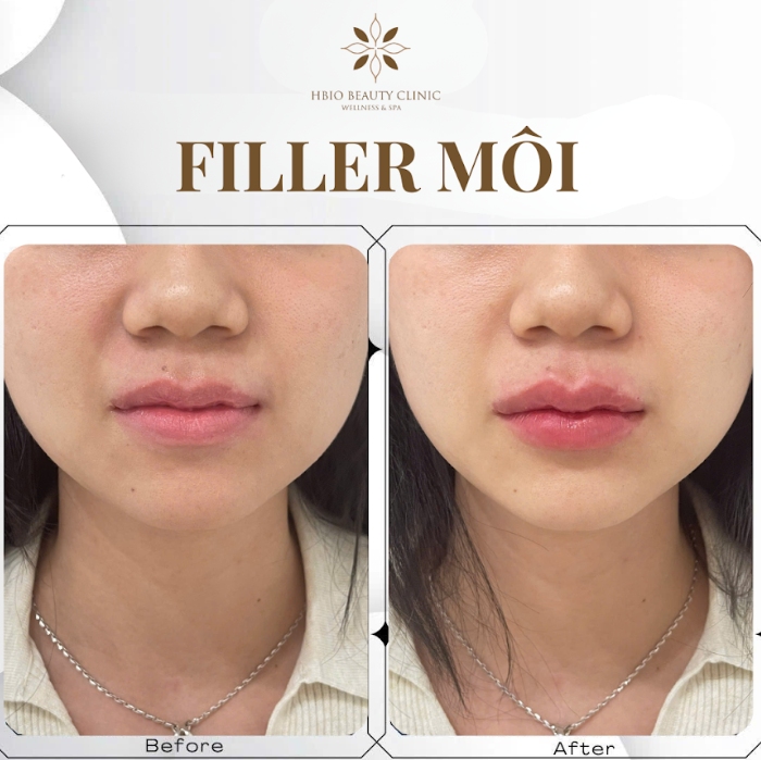 Khách hành thực hiện tiêm filler môi tại HBIO Clinic