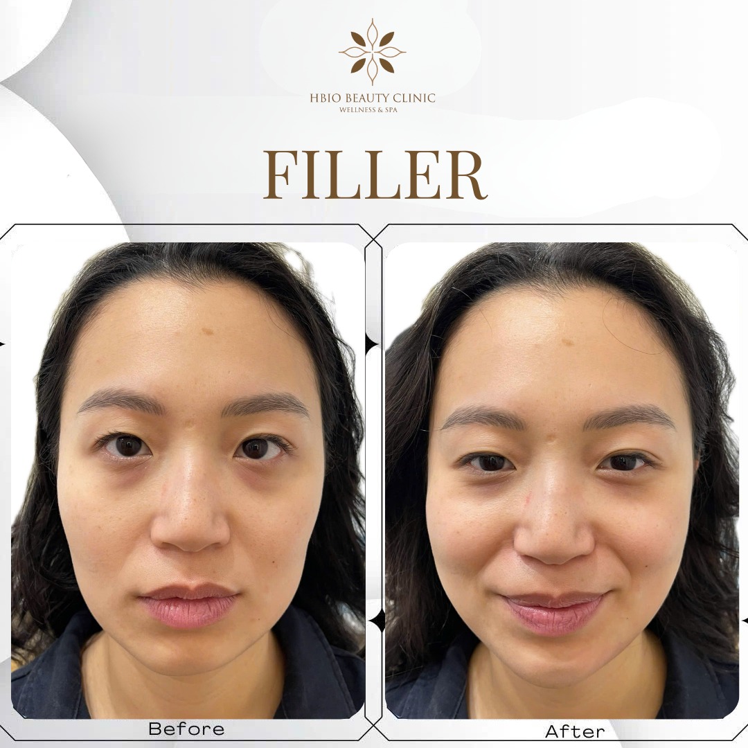 Quy trình tiêm filler thái dương an toàn