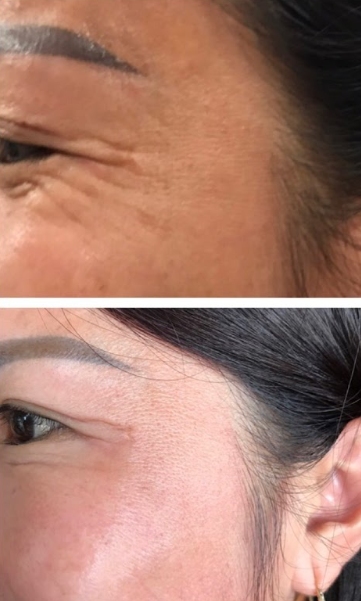 Trải nghiệm dịch vụ Filler rãnh lệ chuẩn y khoa tại HBIO Clinic