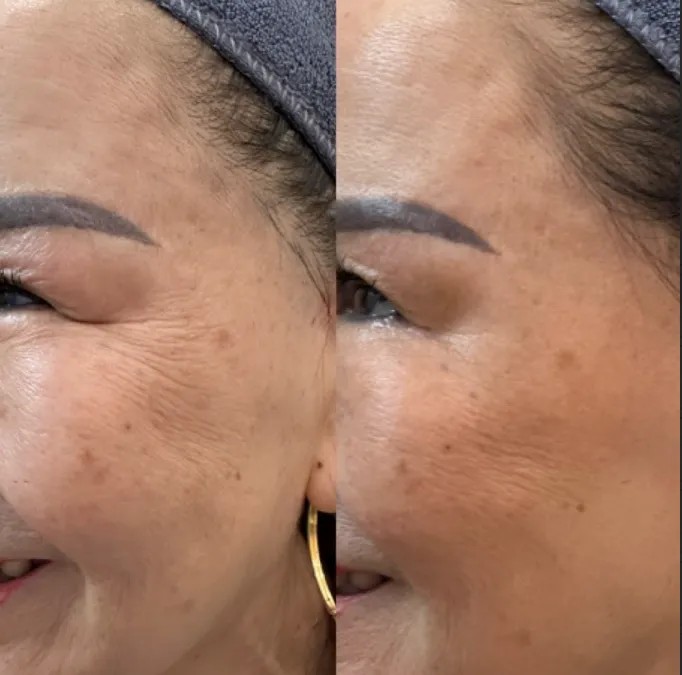 Trải nghiệm dịch vụ Filler rãnh lệ chuẩn y khoa tại HBIO Clinic