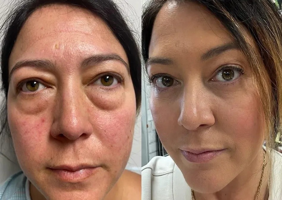 Trước và sau khi tiêm filler xóa rãnh lệ tại HBIO Clinic