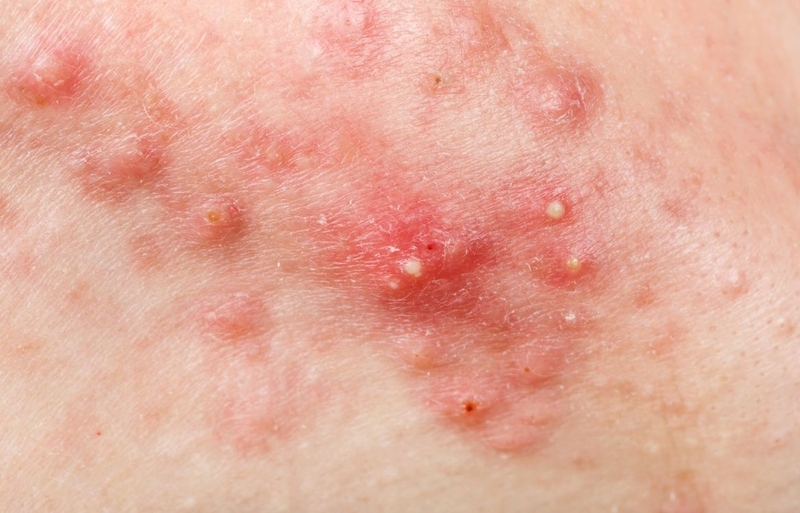Trường hợp nào mụn viêm không nên peel da