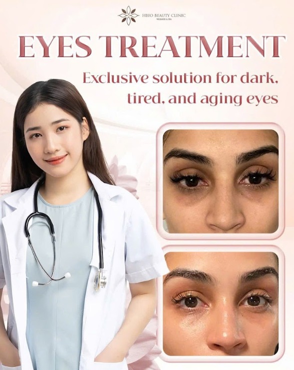 Điều trị quầng thâm mắt tại HBIO Clinic