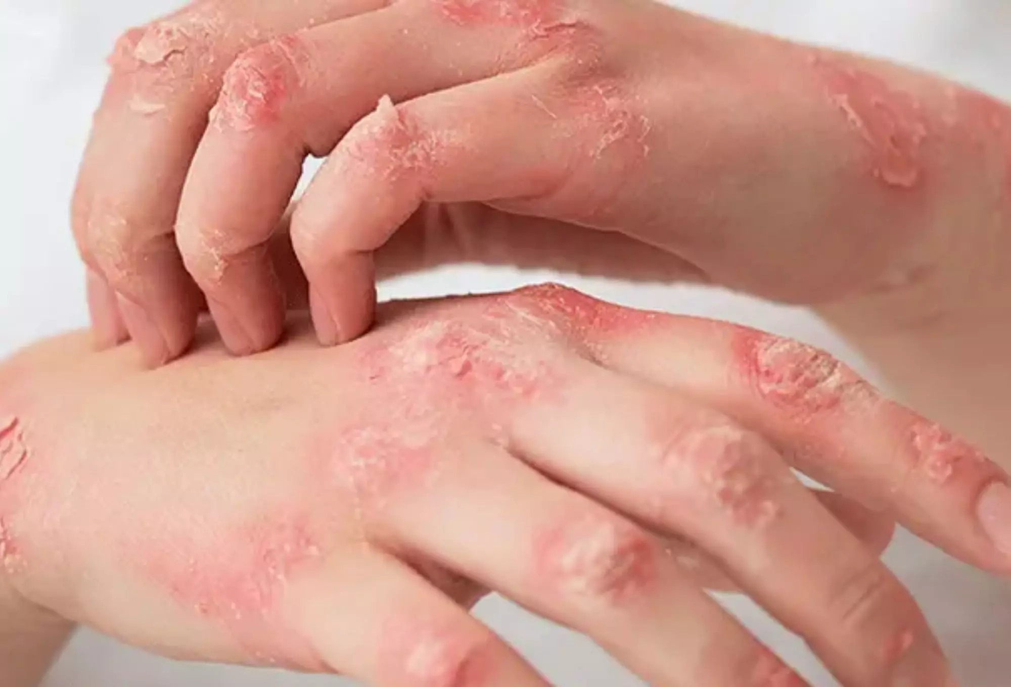 Lưu ý cần tuân thủ trong cách trị chàm khô