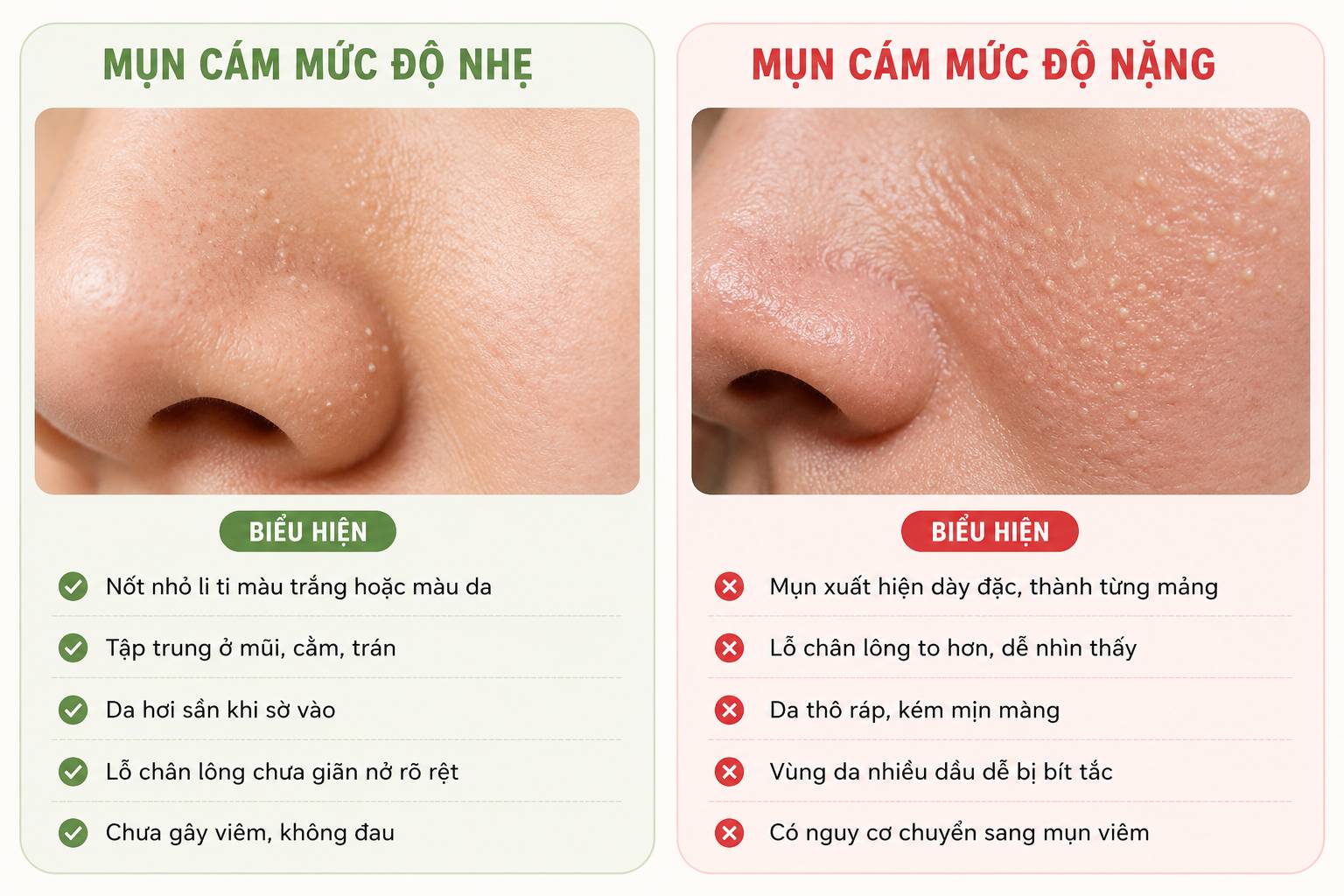 Dấu hiệu nhận biết mụn cám
