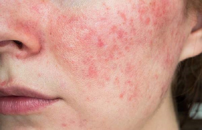 Nguyên nhân khiến da mặt trở nên mỏng và nhạy cảm phổ biến