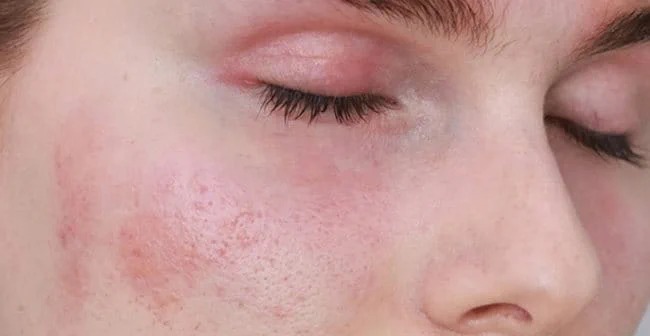 Nhận biết da mặt mỏng nhạy cảm như thế nào?