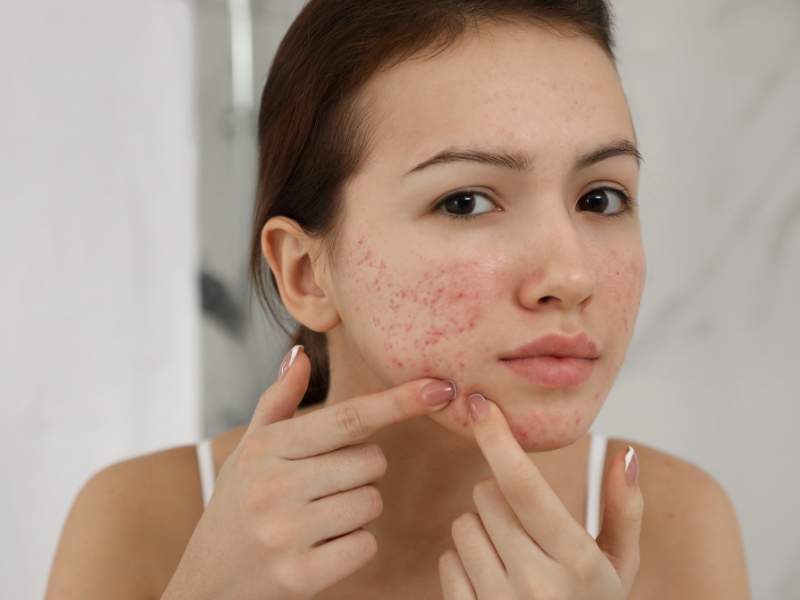 Da sau điều trị có nên dùng nước hoa hồng chứa cồn không?