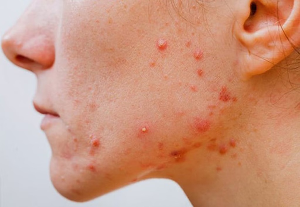 Trường hợp cần cẩn trọng khi lăn kim