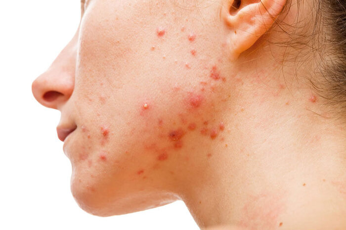 Hiện tượng sừng hóa cổ nang lông khiến mụn L70 sinh sôi