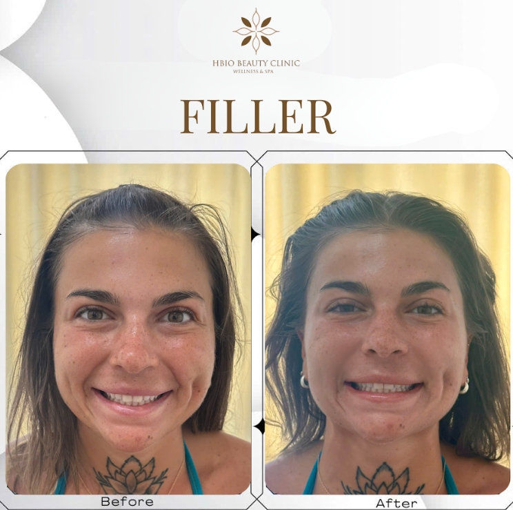 Tiêm filler tại HBIO Clinic