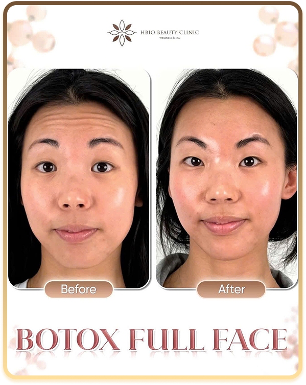 Tiêm Botox làm mờ nếp nhăn