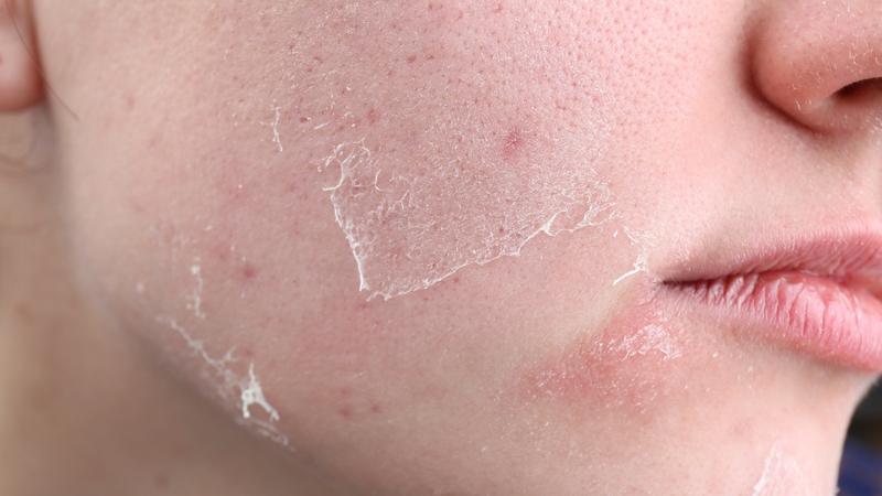 Trước khi peel da