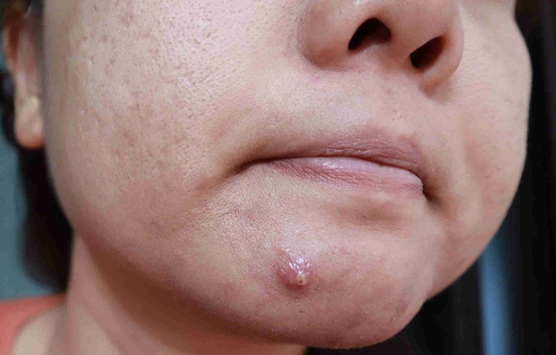 Giai đoạn mụn bọc chín muồi
