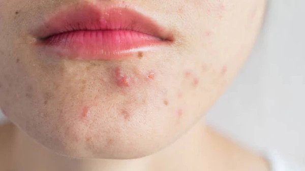Dấu hiệu nhận biết mụn viêm ở cằm
