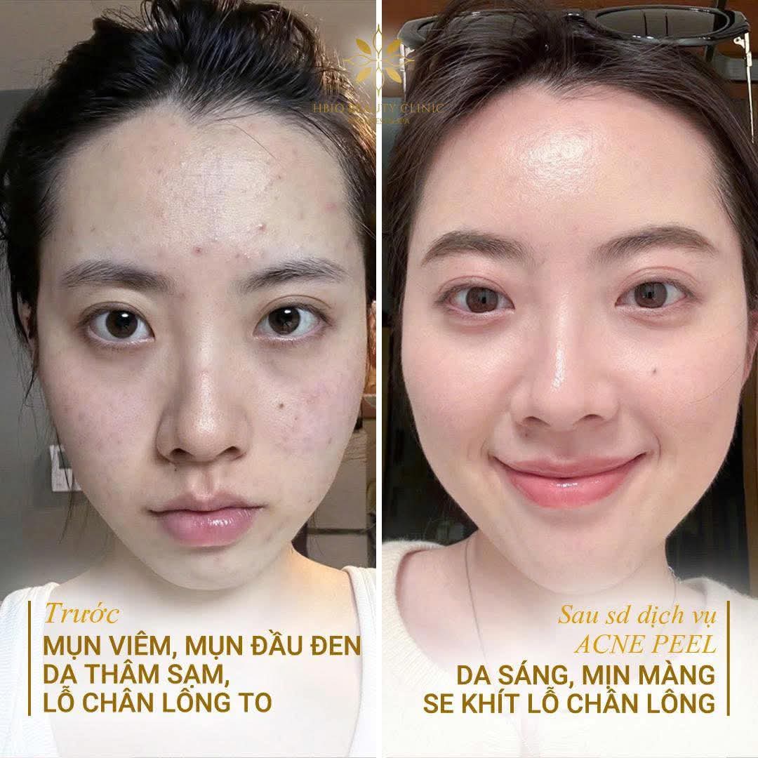 Ảnh thực tế trước và sau khi peel da