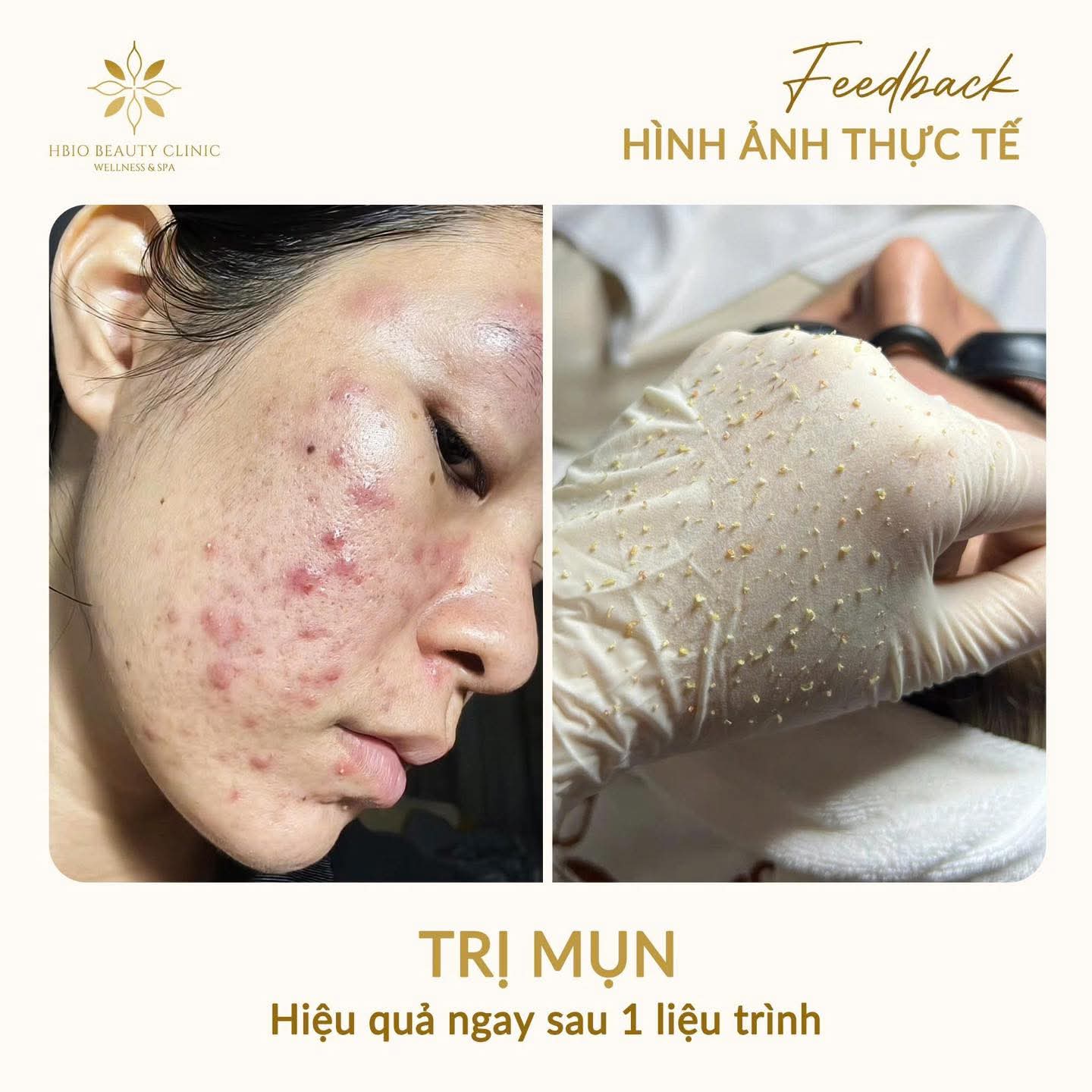 Ảnh thực tế trước và sau khi peel da