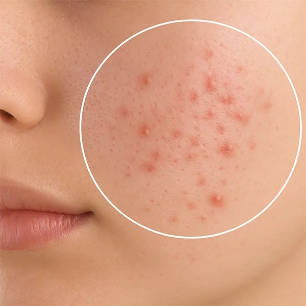 Dấu hiệu nhận biết chính xác mụn viêm ở má 