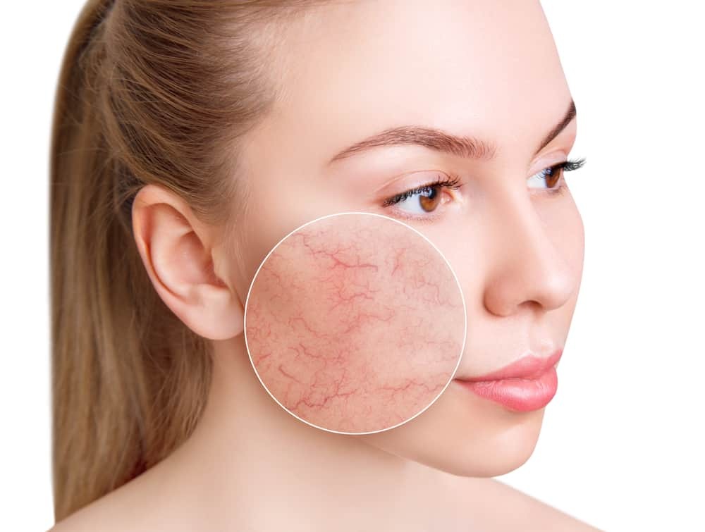 Dấu hiệu nhận biết sớm tình trạng rạn da trên khuôn mặt
