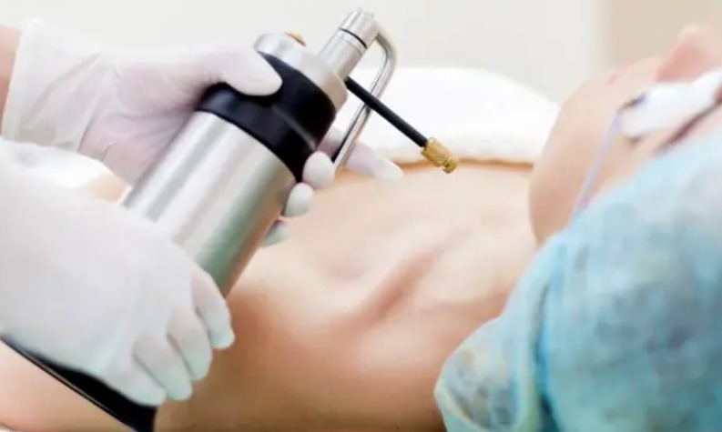 Điều trị sẹo lồi bằng phương pháp áp lạnh 