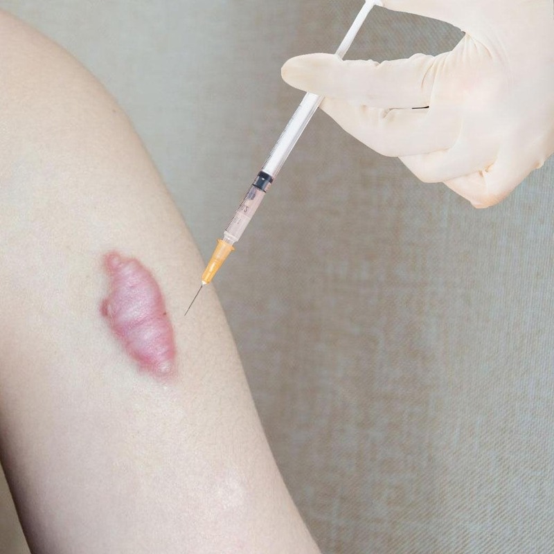 Tiêm corticoid trị sẹo lồi